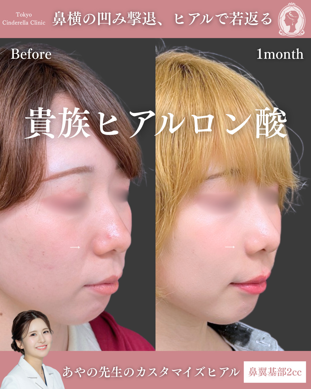 新宿院で行ったヒアルロン酸注入の名医の梅田彩乃医師の症例写真