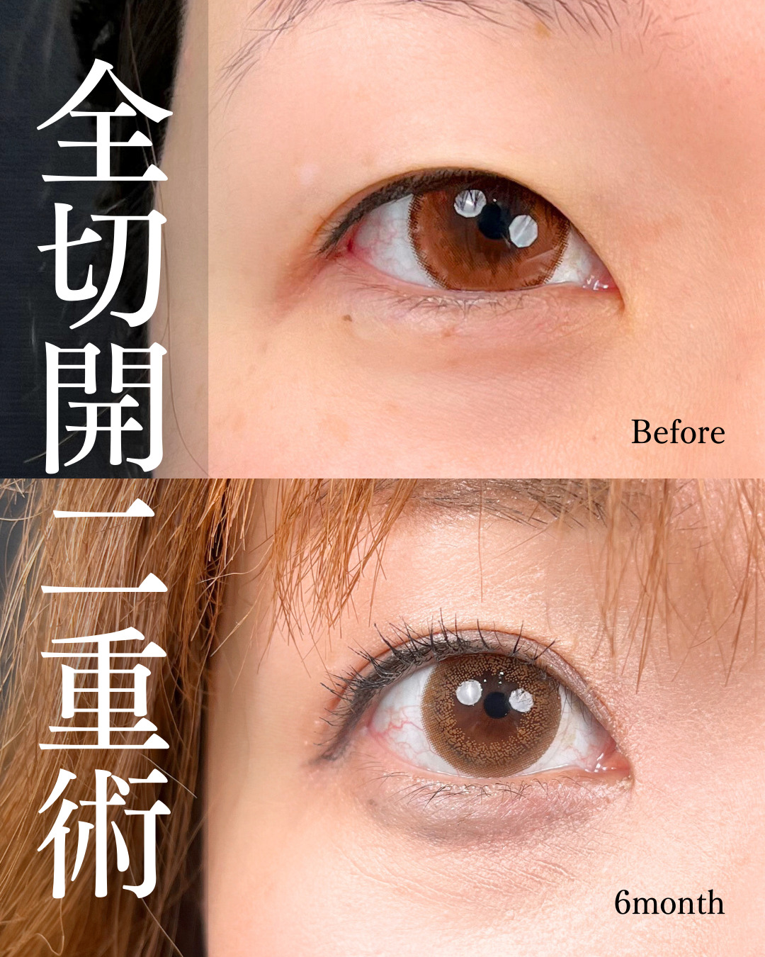 大宮院で行った二重整形で有名な名医の全切開二重術と目頭切開の症例写真