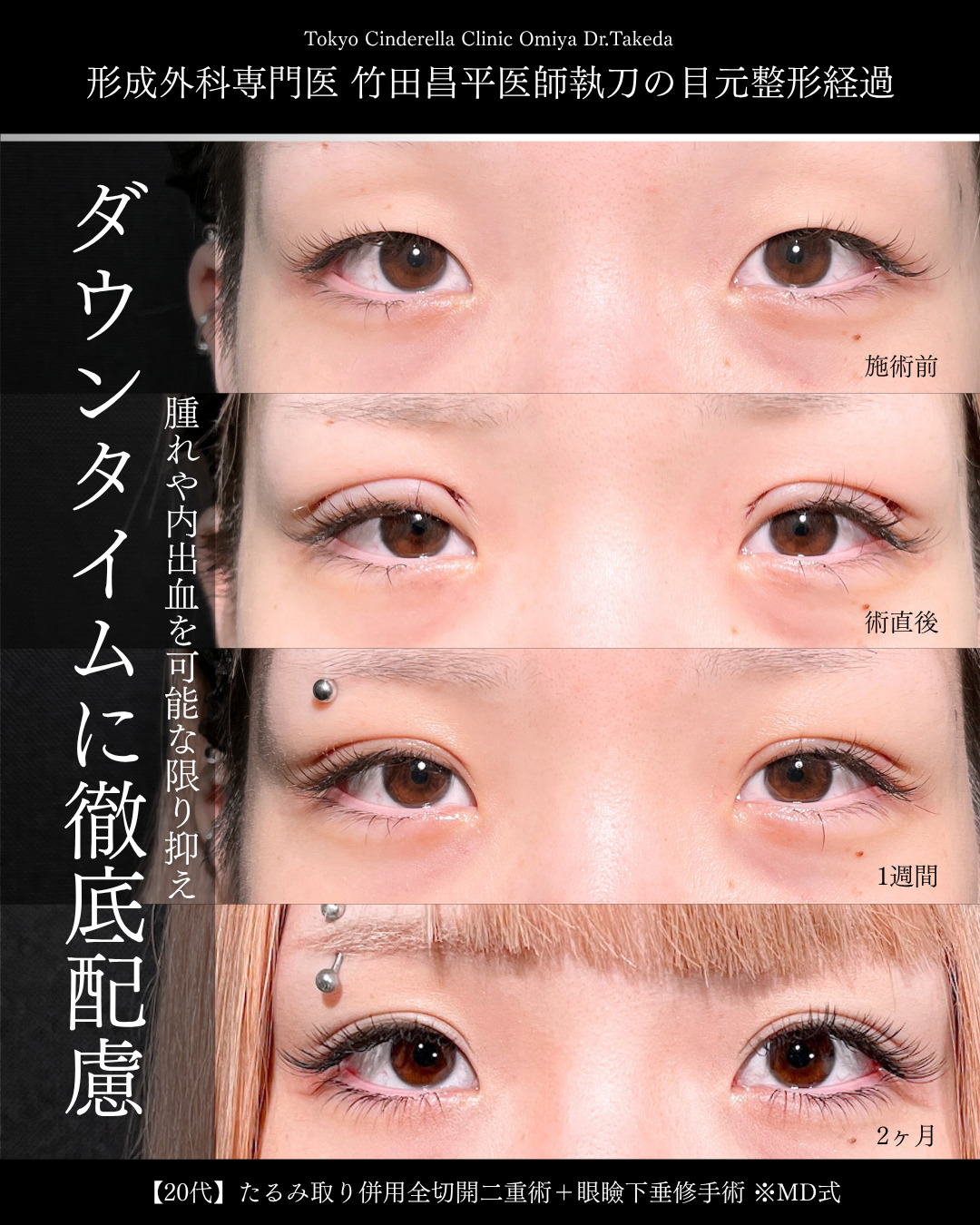 大宮院で行った二重整形で有名な竹田昌平医師のMD式のたるみ取り併用全切開法二重術と眼瞼下垂手術の経過症例写真