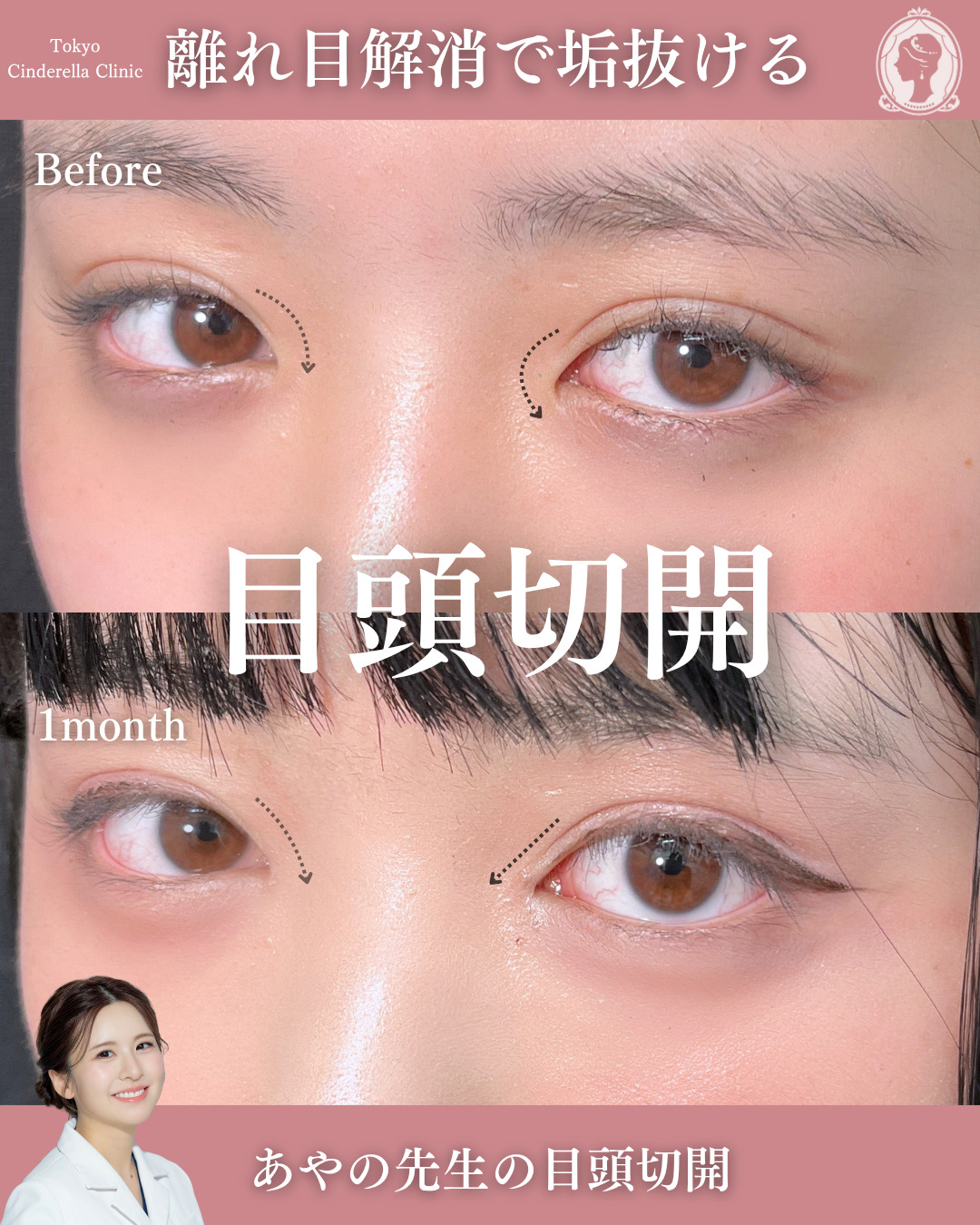 新宿院で行った目頭切開の名医の梅田彩乃医師の症例写真