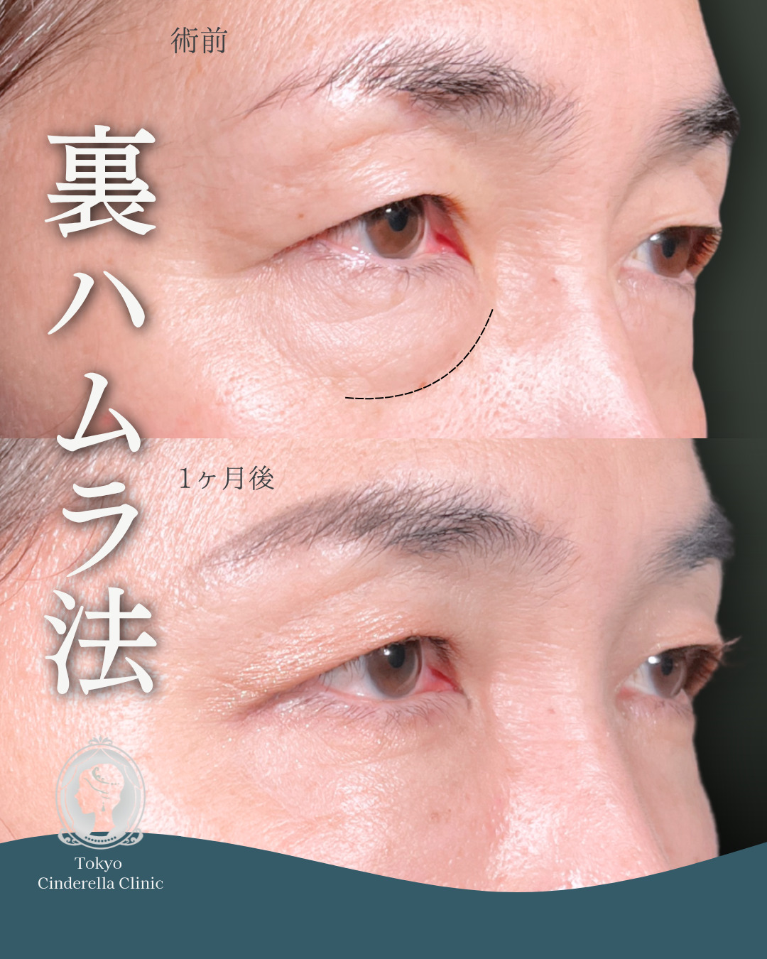 新宿院で行ったMD式の裏ハムラ法の名医の吉田利之医師の症例写真
