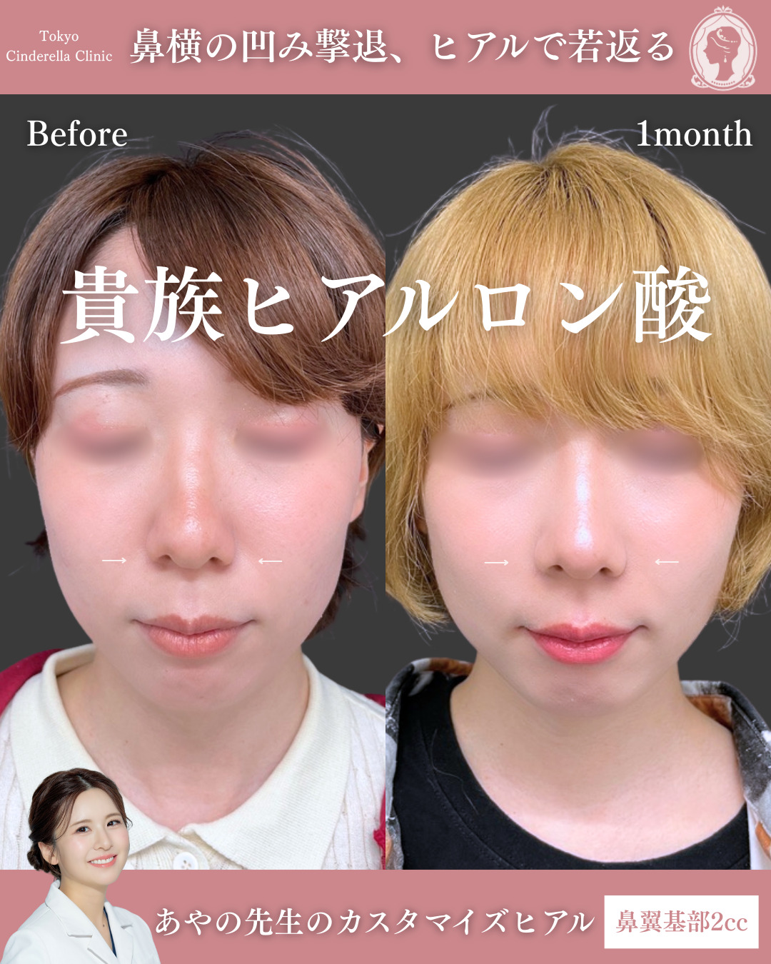 新宿院で行ったヒアルロン酸注入の名医の梅田彩乃医師の症例写真