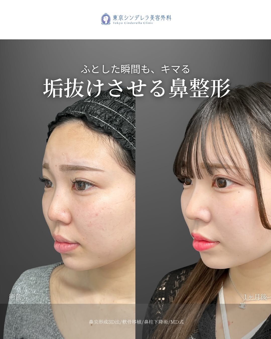 新宿院で行った鼻整形の名医の吉原伯医師のMD式の鼻尖形成3D法と軟骨移植と鼻柱下降術の症例写真