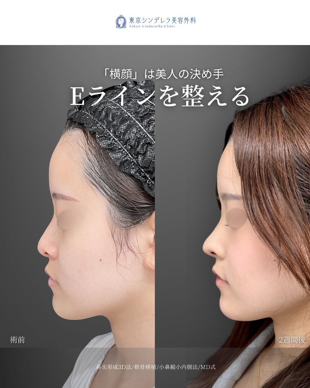 新宿院で行った鼻整形の名医の吉原伯医師のMD式の鼻尖形成3D法と軟骨移植と小鼻縮小内側法の症例写真