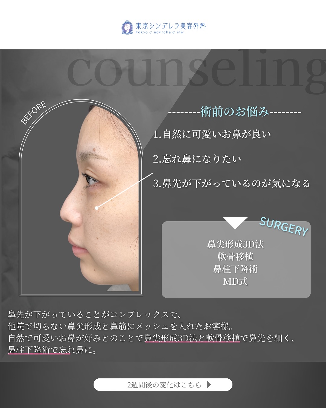 新宿院で行った鼻整形の名医の吉原伯医師のMD式の鼻尖形成3D法と軟骨移植の症例写真
