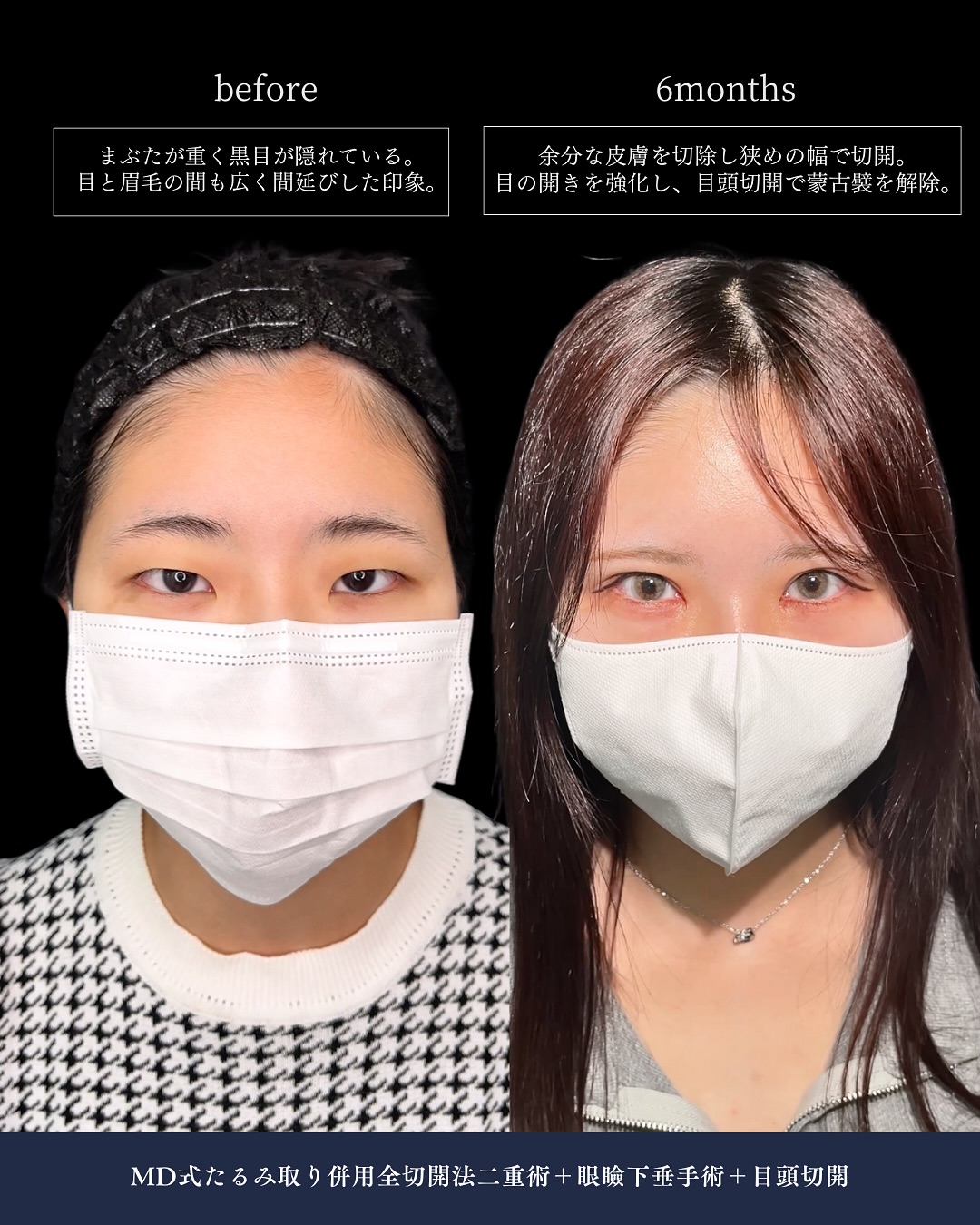 新宿院で行った二重整形で有名な吉原伯医師のMD式のたるみ取り併用全切開法二重術と眼瞼下垂手術と目頭切開の6ヶ月後の症例写真