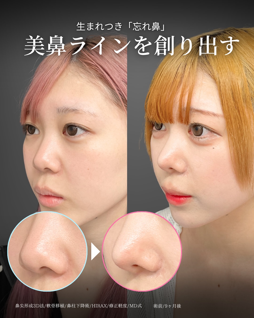 新宿院で行った鼻整形の名医の吉原伯医師のMD式の鼻尖形成3D法と軟骨移植と鼻柱下降術とHIRAXと他院修正の症例写真
