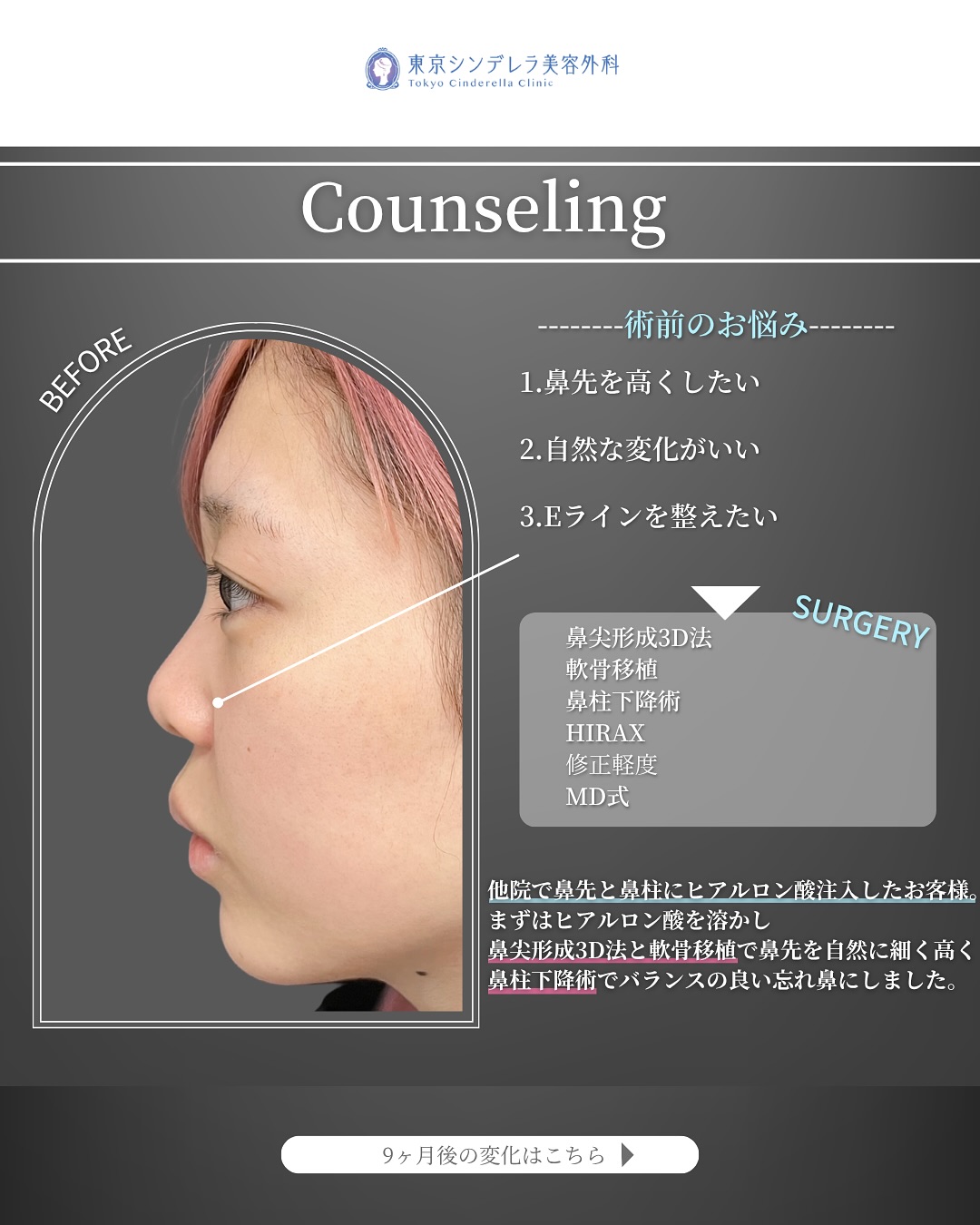 新宿院で行った鼻整形の名医の吉原伯医師のMD式の鼻尖形成3D法と軟骨移植と鼻柱下降術とHIRAXと他院修正の症例写真