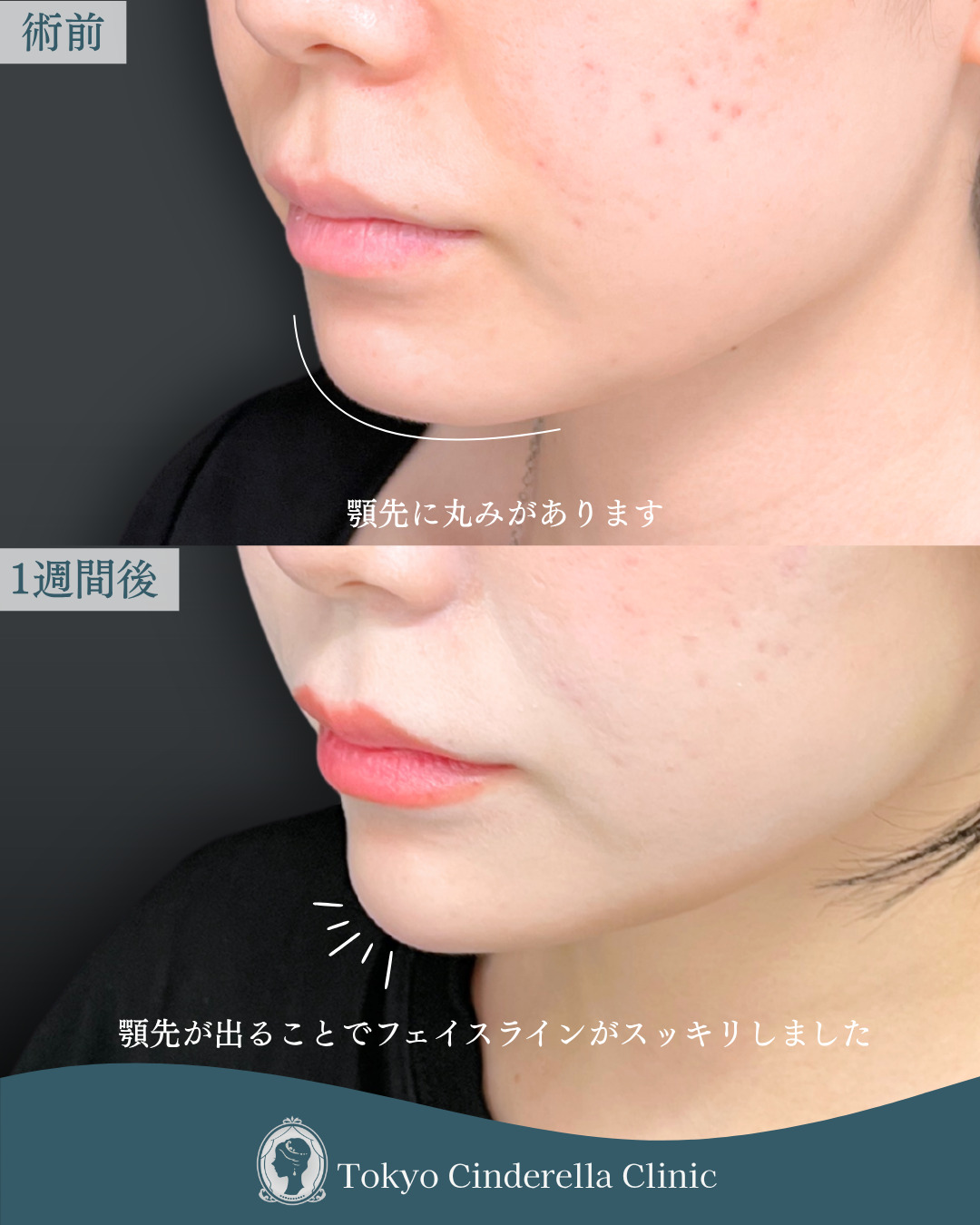新宿院で行ったヒアルロン酸(アゴ)とボツリヌス注射(エラ・アゴ・眉間）の名医の吉田利之医師の症例写真