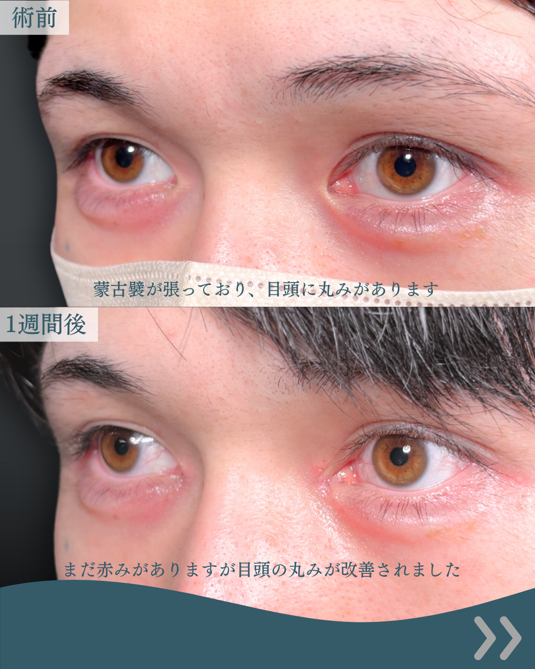 新宿院で行った目頭切開の名医の吉田利之医師の症例写真