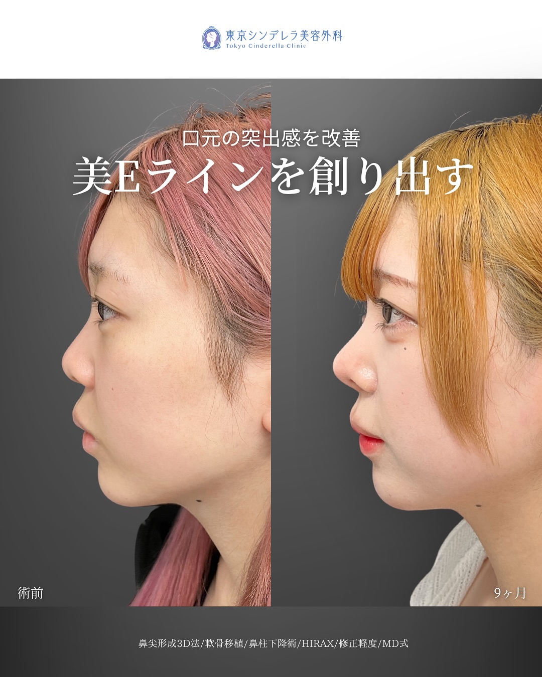 新宿院で行った鼻整形の名医の吉原伯医師のMD式の鼻尖形成3D法と軟骨移植と鼻柱下降術とHIRAXと他院修正の症例写真