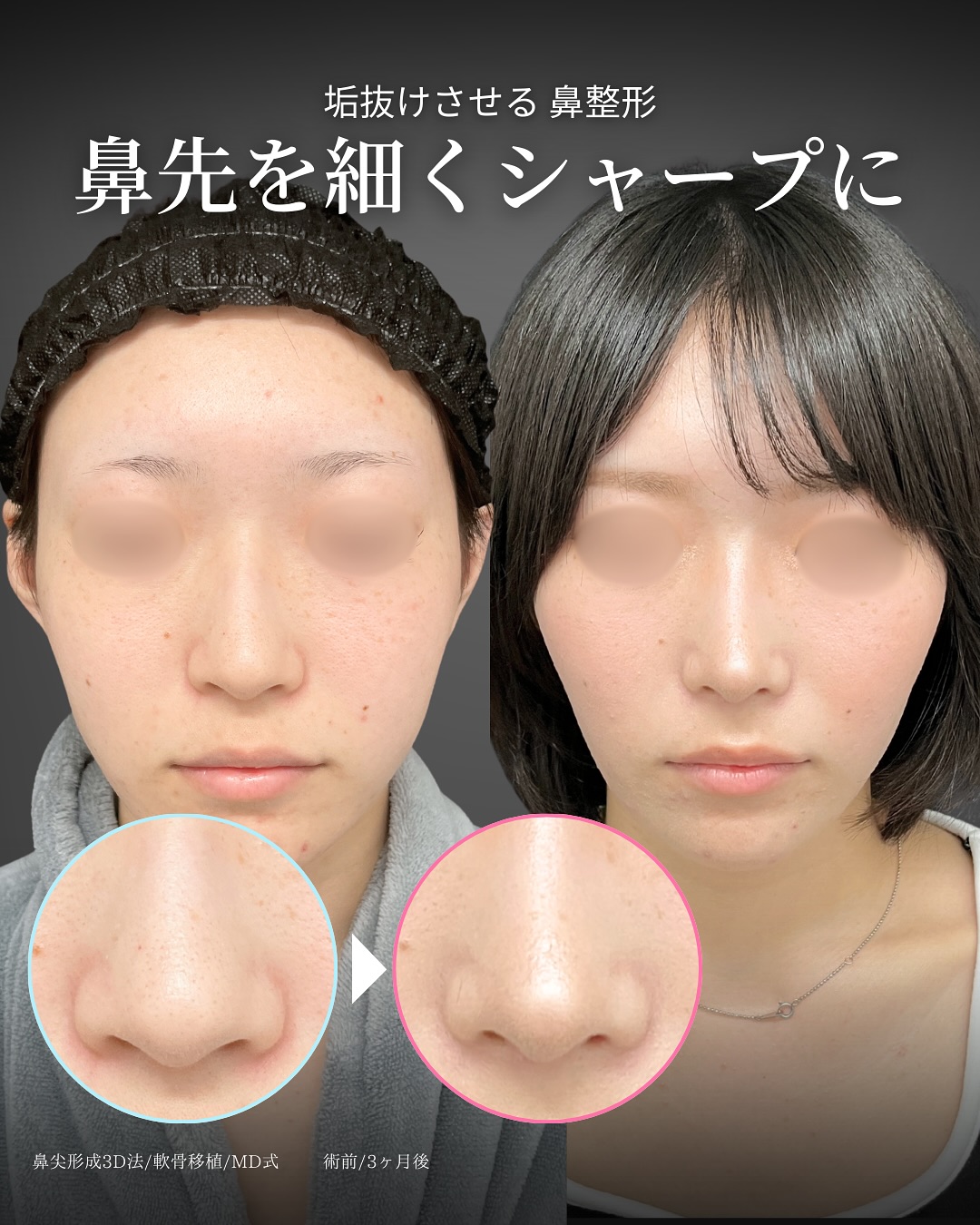 新宿院で行った鼻整形の名医の吉原伯医師のMD式の鼻尖形成3D法と軟骨移植の症例写真