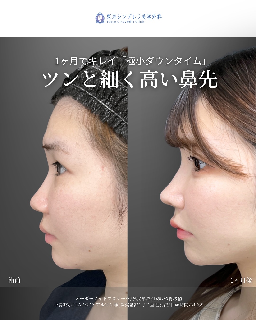 新宿院で行った二重整形の名医の吉原伯医師のMD式の鼻尖形成3D法と軟骨移植と小鼻縮小FLAP法とヒアルロン酸(鼻翼基部)と二重埋没法と目頭切開の症例写真