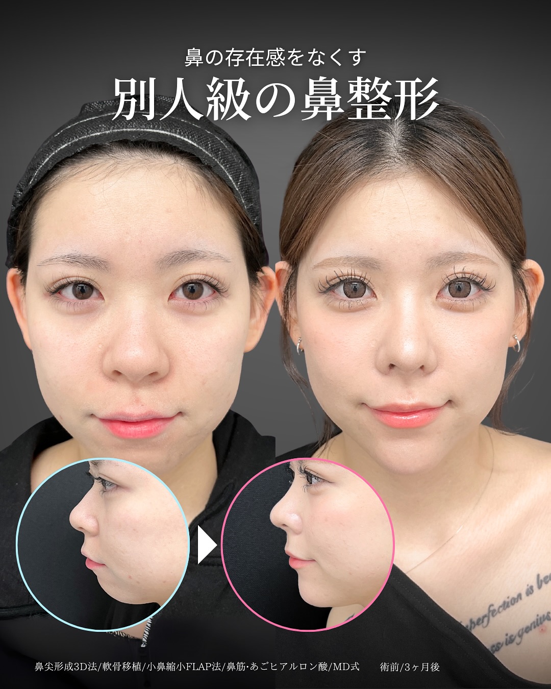 新宿院で行った鼻整形の名医の吉原伯医師のMD式の鼻尖形成3D法と軟骨移植と小鼻縮小FLAP法とあごヒアルロン酸の症例写真