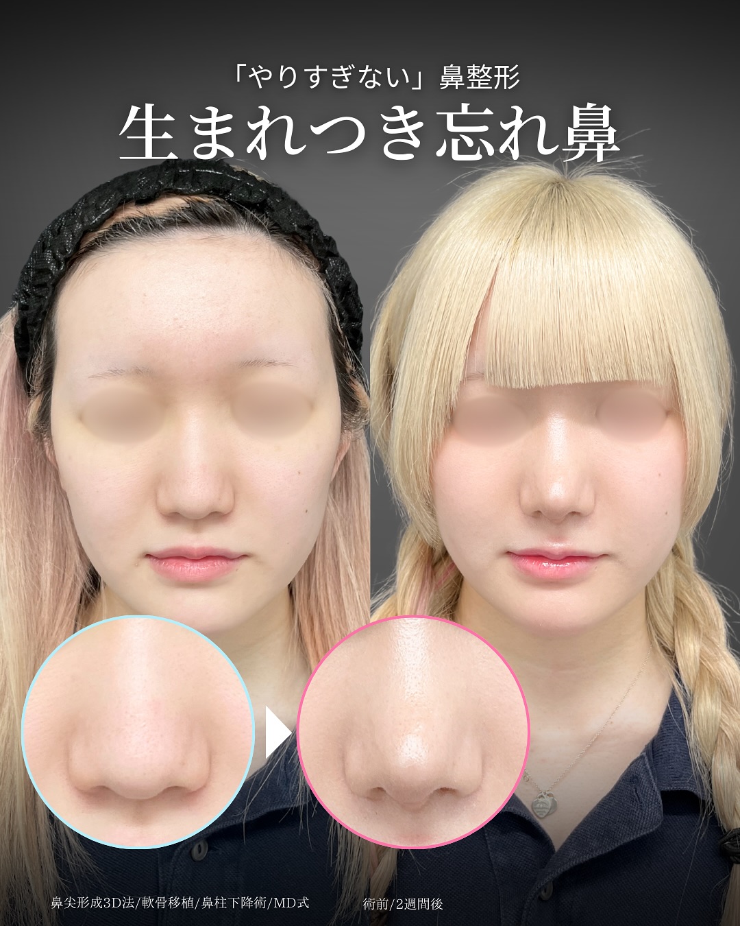 新宿院で行った鼻整形の名医の吉原伯医師のMD式の鼻尖形成3D法と軟骨移植と鼻柱下降術の症例写真