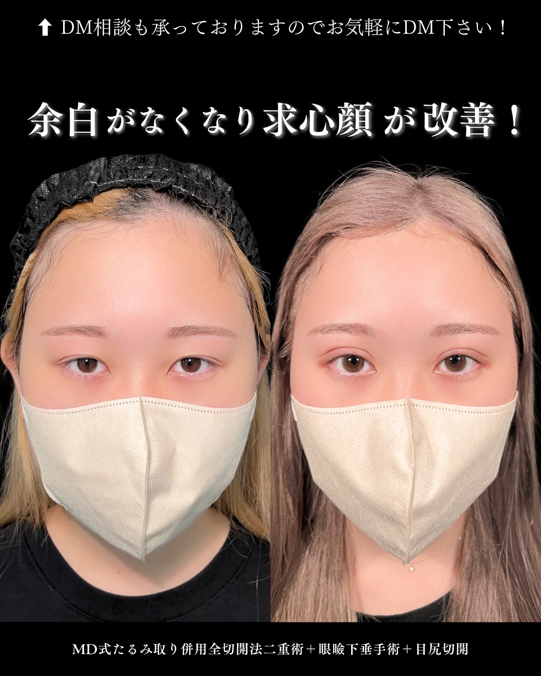 新宿院で行った二重整形の名医の吉原伯医師のMD式のたるみ取り併用全切開法二重術と眼瞼下垂手術と目尻切開の症例写真