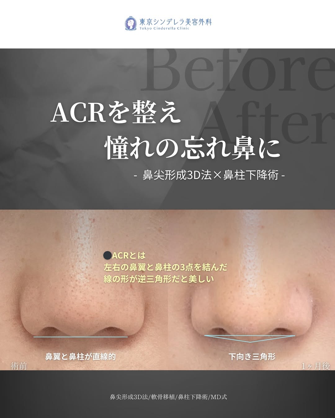 新宿院で行った鼻整形の名医の吉原伯医師のMD式の鼻尖形成3D法と軟骨移植と鼻柱下降術の症例写真