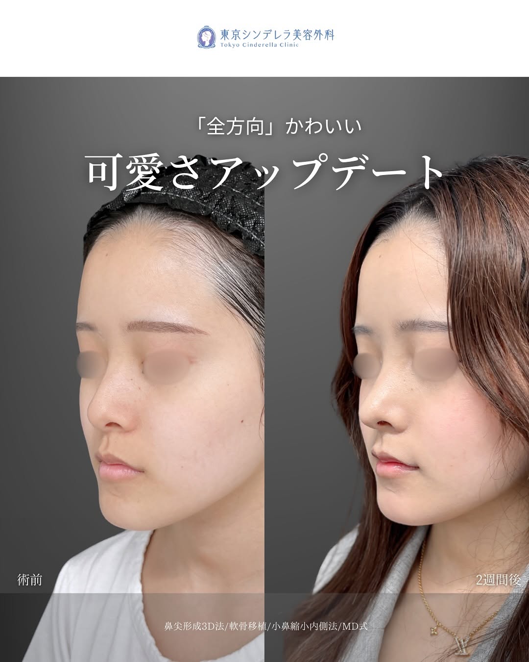 新宿院で行った鼻整形の名医の吉原伯医師のMD式の鼻尖形成3D法と軟骨移植と小鼻縮小内側法の症例写真
