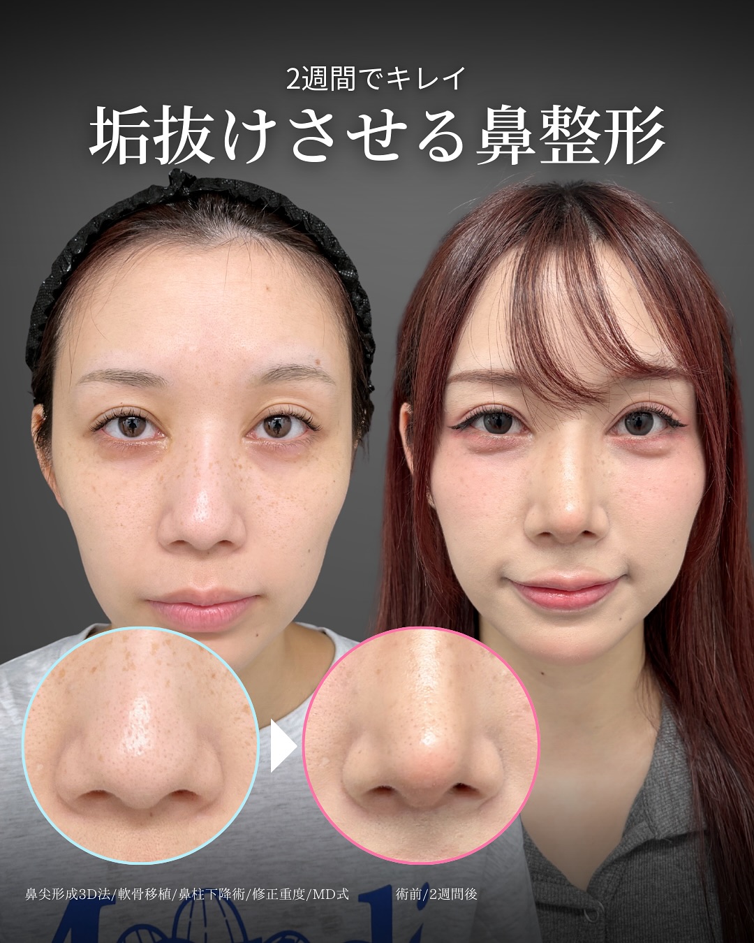 新宿院で行った鼻整形の名医の吉原伯医師のMD式の鼻尖形成3D法と軟骨移植の症例写真