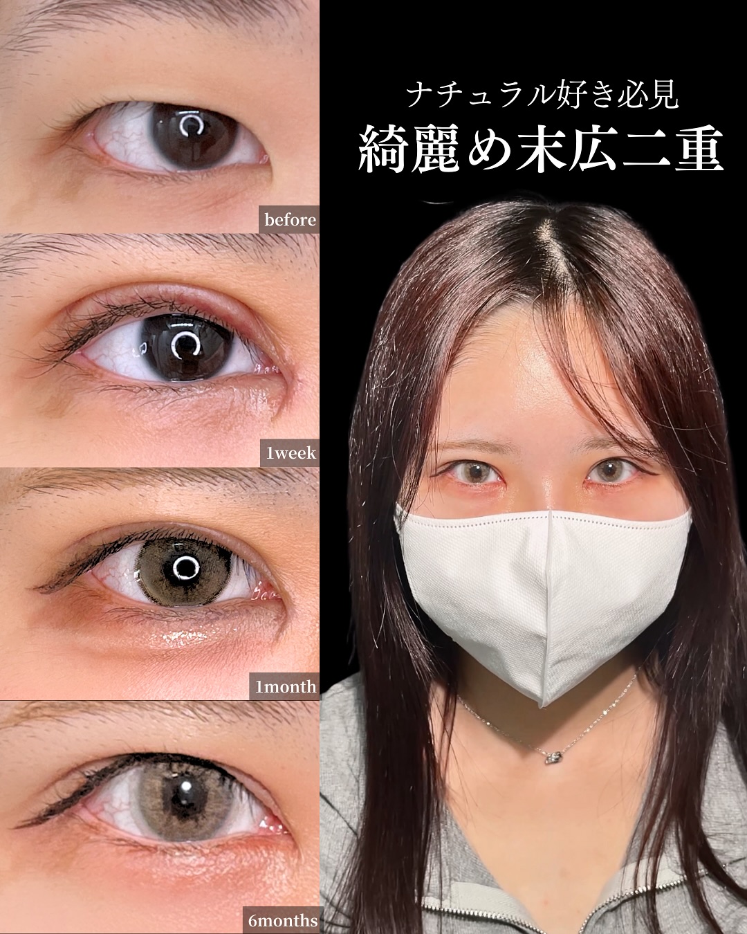 新宿院で行った二重整形で有名な吉原伯医師のMD式のたるみ取り併用全切開法二重術と眼瞼下垂手術と目頭切開の6ヶ月後の症例写真