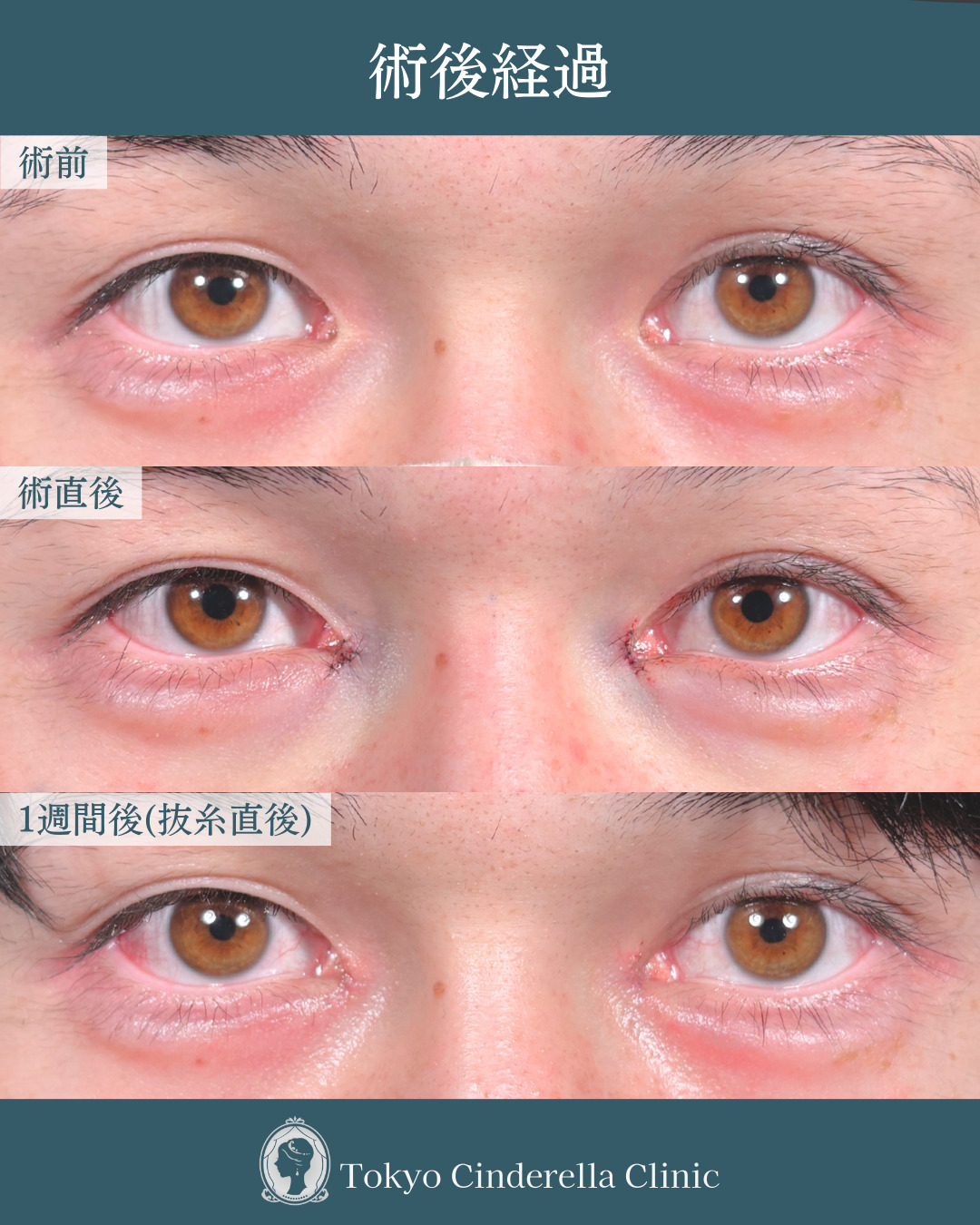 新宿院で行った目頭切開の名医の吉田利之医師の症例写真
