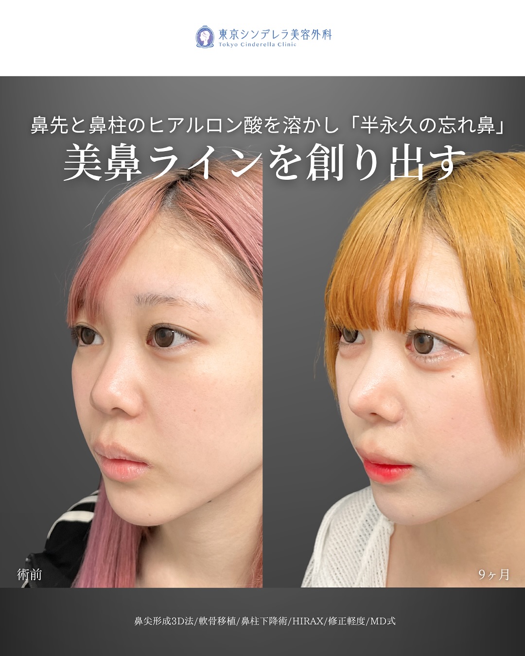 新宿院で行った鼻整形の名医の吉原伯医師のMD式の鼻尖形成3D法と軟骨移植と鼻柱下降術とHIRAXと他院修正の症例写真