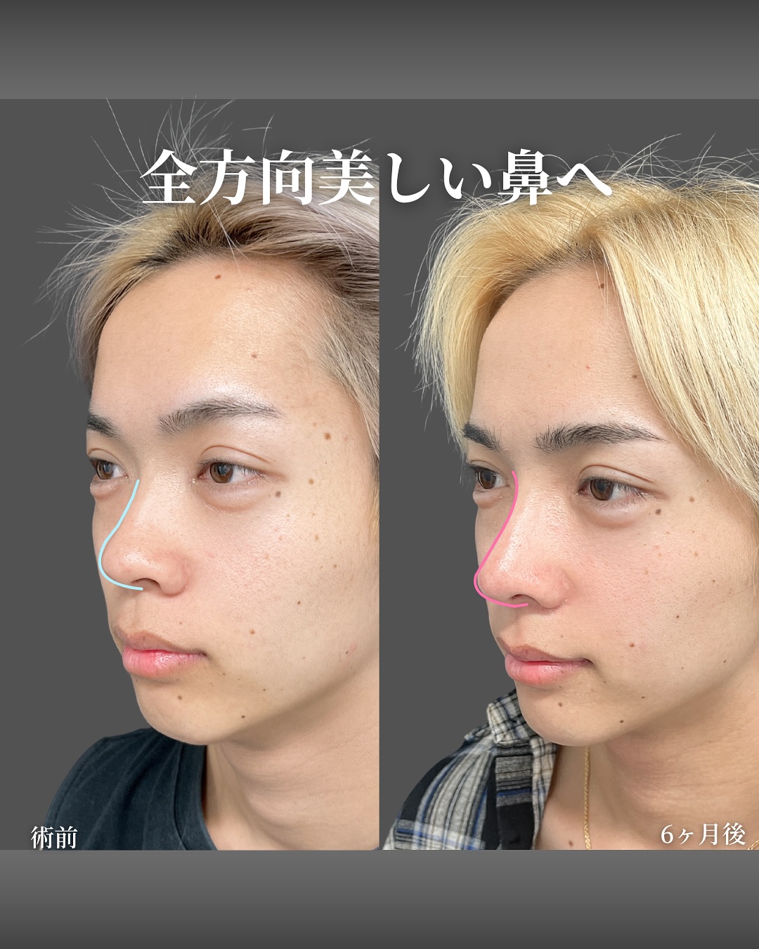 新宿院で行った鼻整形の名医の吉原伯医師のMD式のオーダーメイドプロテーゼと鼻尖形成3D法と軟骨移植と小鼻縮小内外側法と鼻柱下降術の症例写真