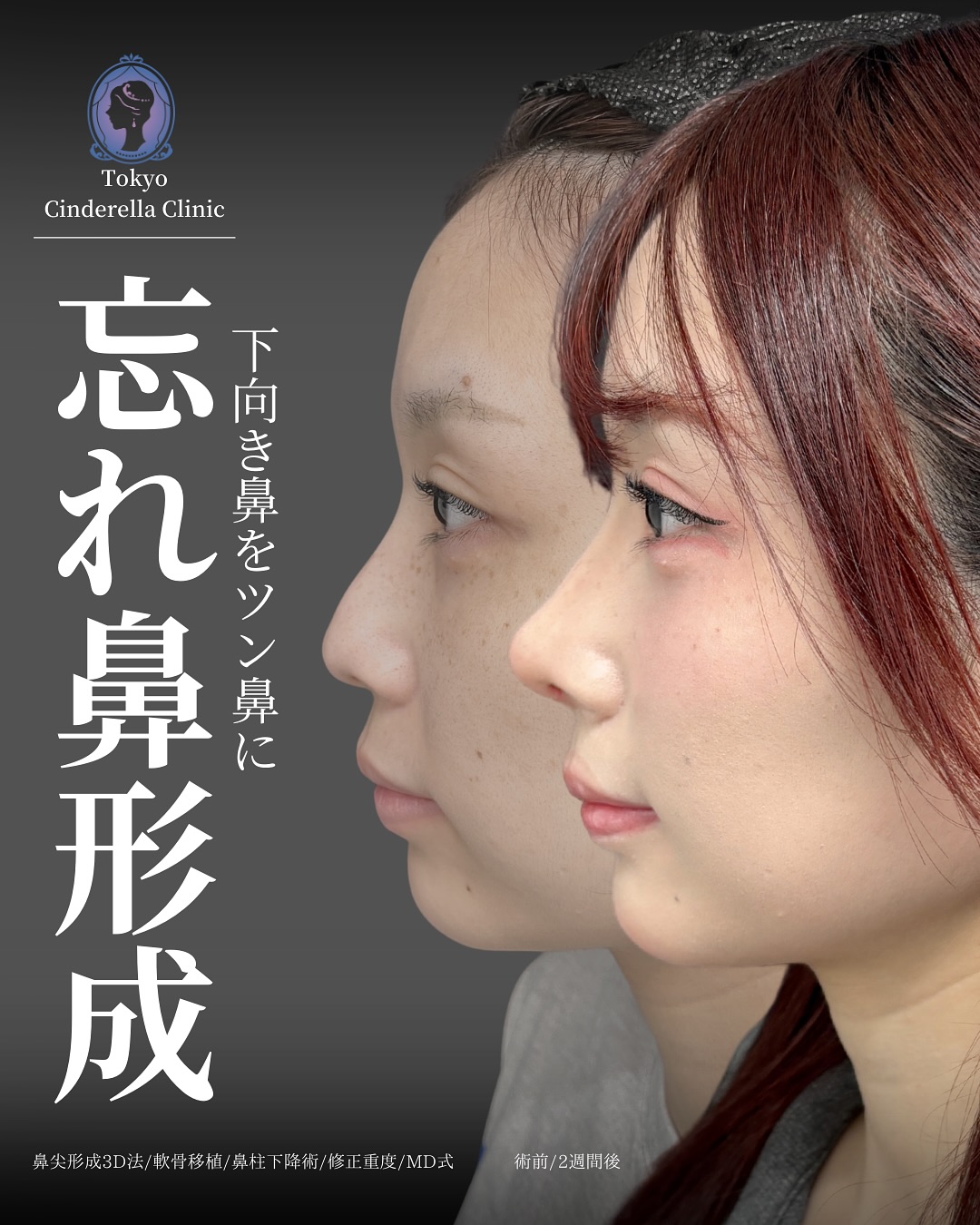 新宿院で行った鼻整形の名医の吉原伯医師のMD式の鼻尖形成3D法と軟骨移植の症例写真