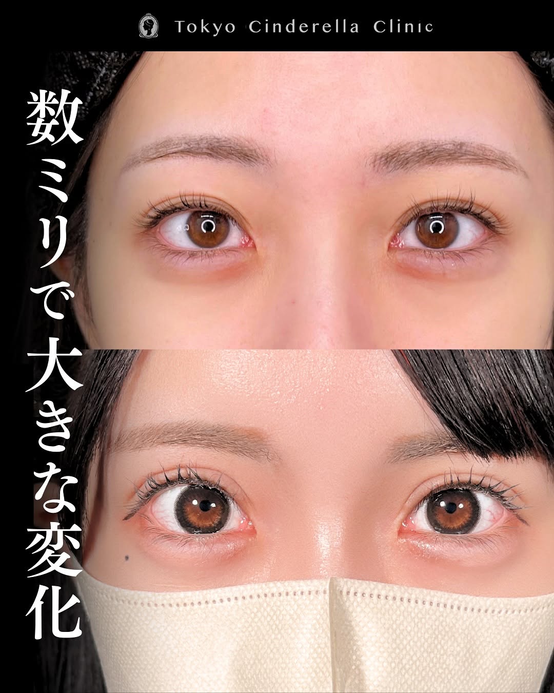 新宿院で行った二重整形で有名な吉原伯医師のMD式のたるみ取り併用全切開法二重術と眼瞼下垂手術と埋没法抜糸の6ヶ月後の症例写真