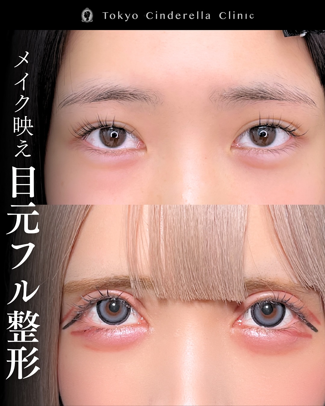 新宿院で行った二重整形で有名な吉原伯医師のMD式のたるみ取り併用全切開法二重術と眼瞼下垂手術と目頭切開とタレ目形成(結膜切開)と切らないクマ取りと埋没法抜糸6ヶ月後の症例写真