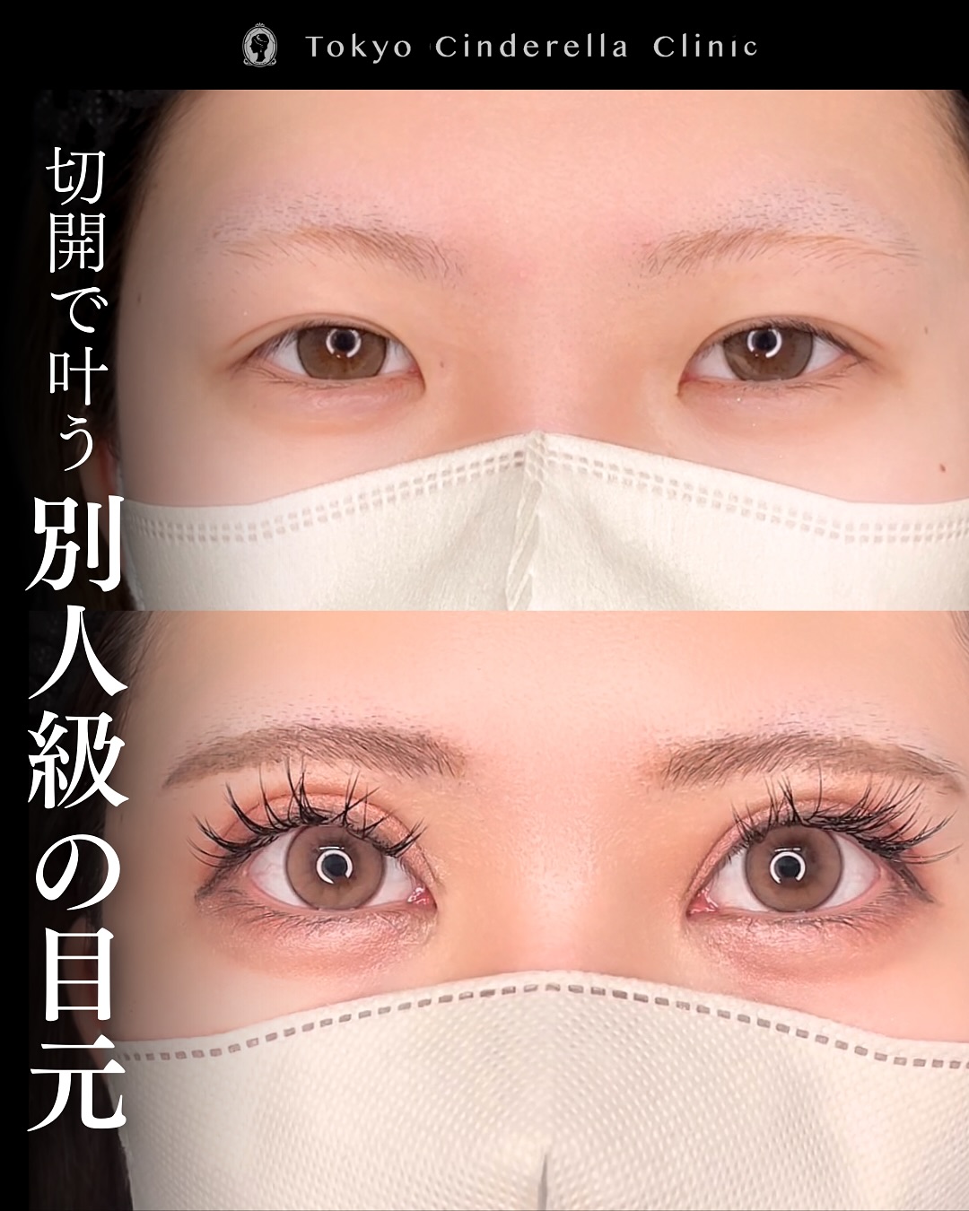 新宿院で行った二重整形で有名な吉原伯医師のMD式のたるみ取り併用全切開法二重術と眼瞼下垂手術と目頭切開と埋没法抜糸の3ヶ月後の症例写真