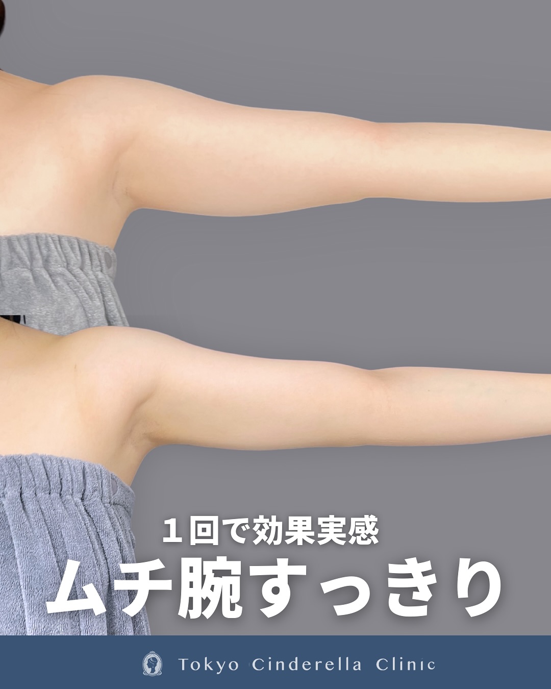 新宿院で行ったアキーセル脂肪吸引(二の腕・肩)の名医の吉原伯医師の症例写真