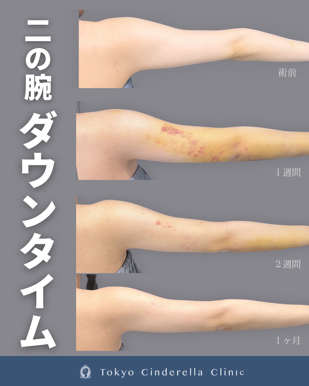 新宿院で行ったアキーセル脂肪吸引(二の腕・肩)の名医の吉原伯医師の症例写真