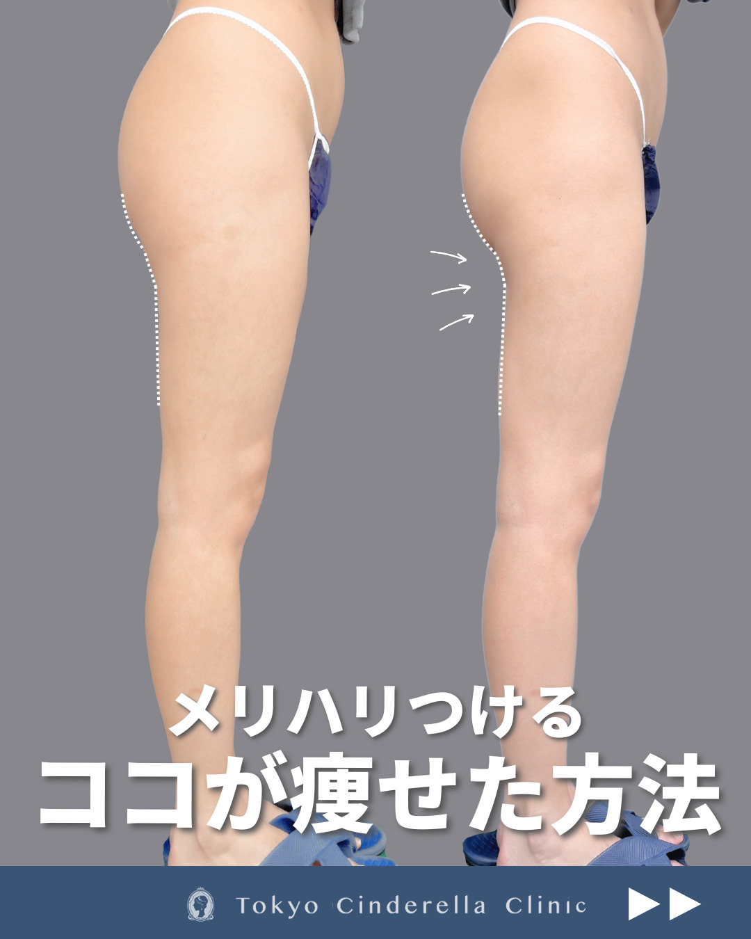 新宿院で行ったアキーセル脂肪吸引(太もも後面・お尻)の名医の吉原伯医師の症例写真
