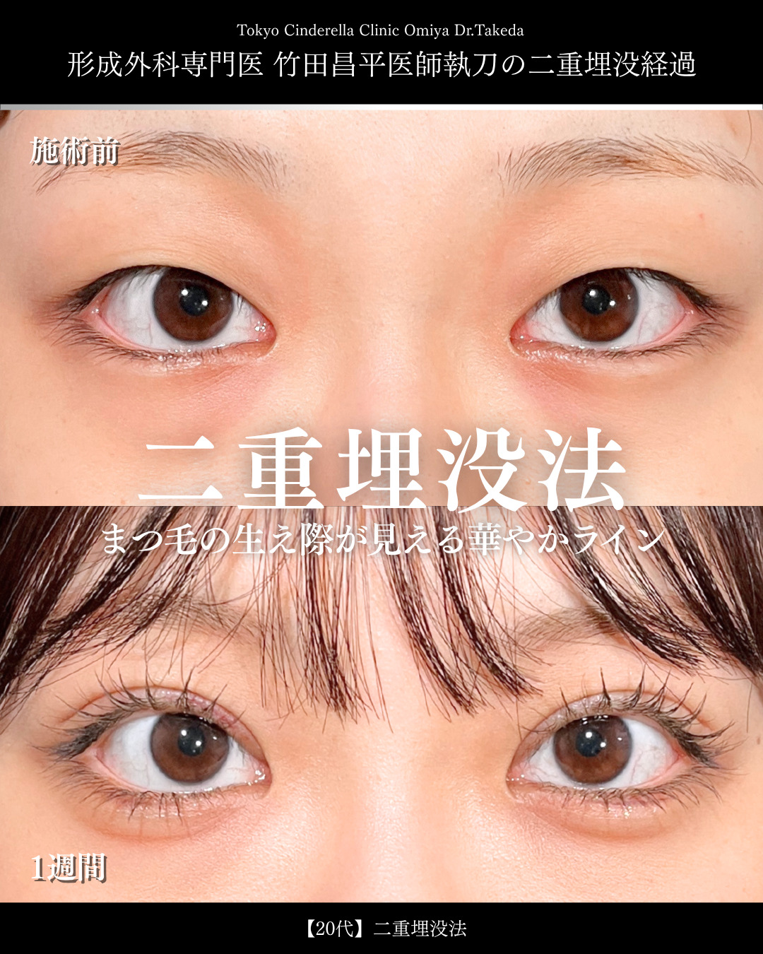 大宮院で行った二重埋没の名医の竹田昌平医師の症例写真