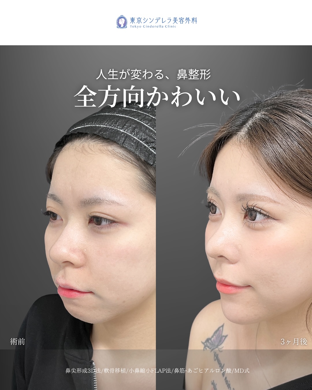 新宿院で行った鼻整形の名医の吉原伯医師のMD式の鼻尖形成3D法と軟骨移植と小鼻縮小FLAP法とあごヒアルロン酸の症例写真
