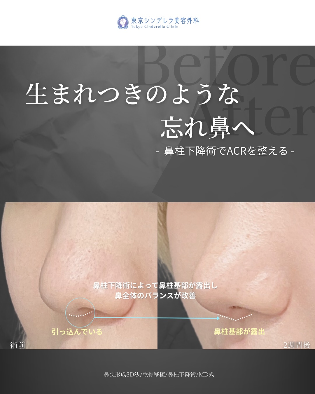 新宿院で行った鼻整形の名医の吉原伯医師のMD式の鼻尖形成3D法と軟骨移植と鼻柱下降術の症例写真