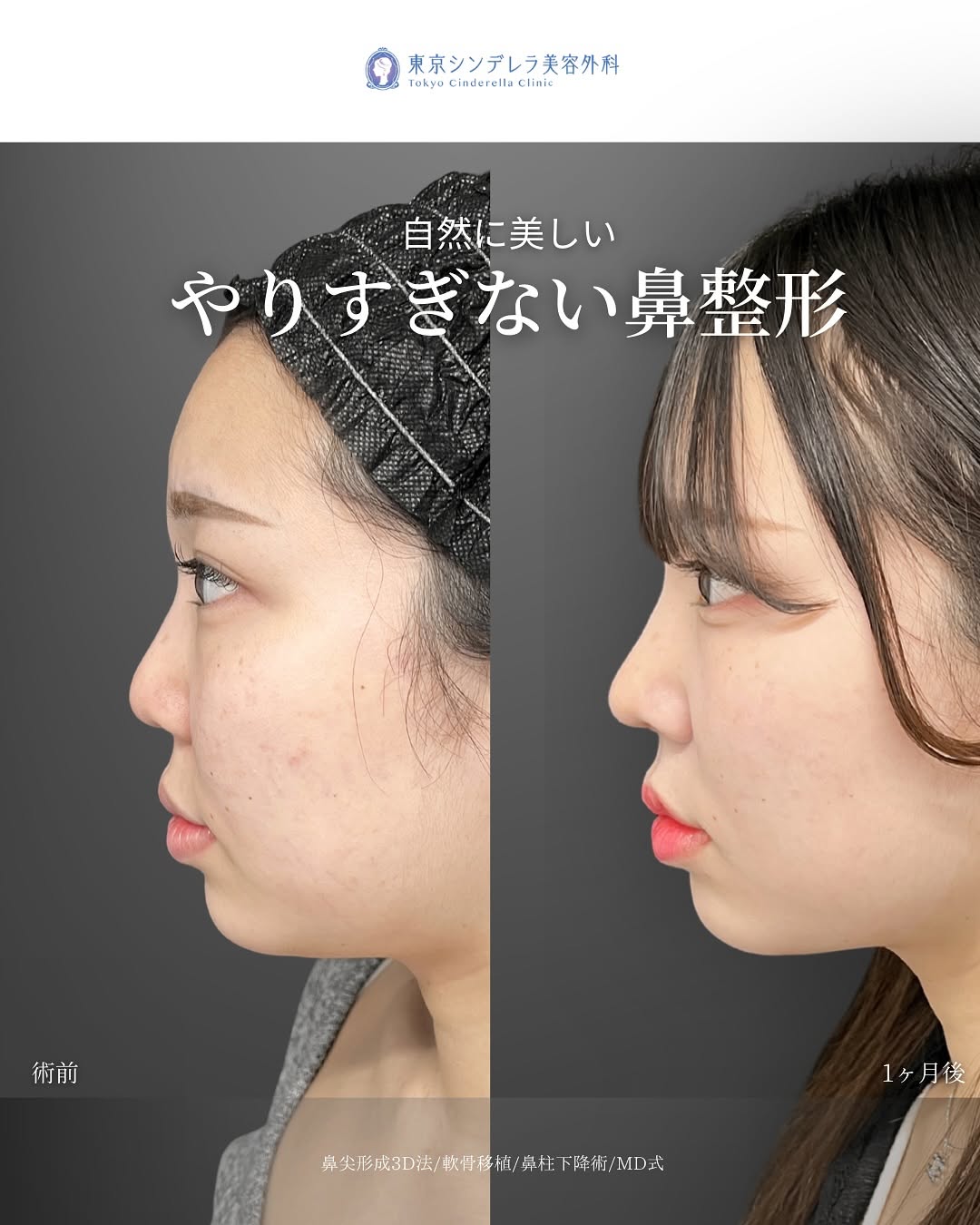 新宿院で行った鼻整形の名医の吉原伯医師のMD式の鼻尖形成3D法と軟骨移植と鼻柱下降術の症例写真
