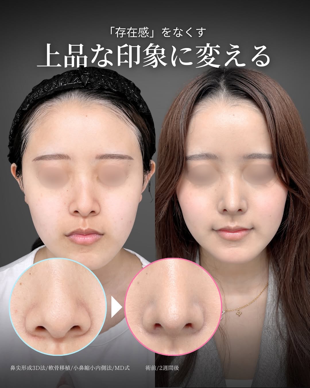新宿院で行った鼻整形の名医の吉原伯医師のMD式の鼻尖形成3D法と軟骨移植と小鼻縮小内側法の症例写真