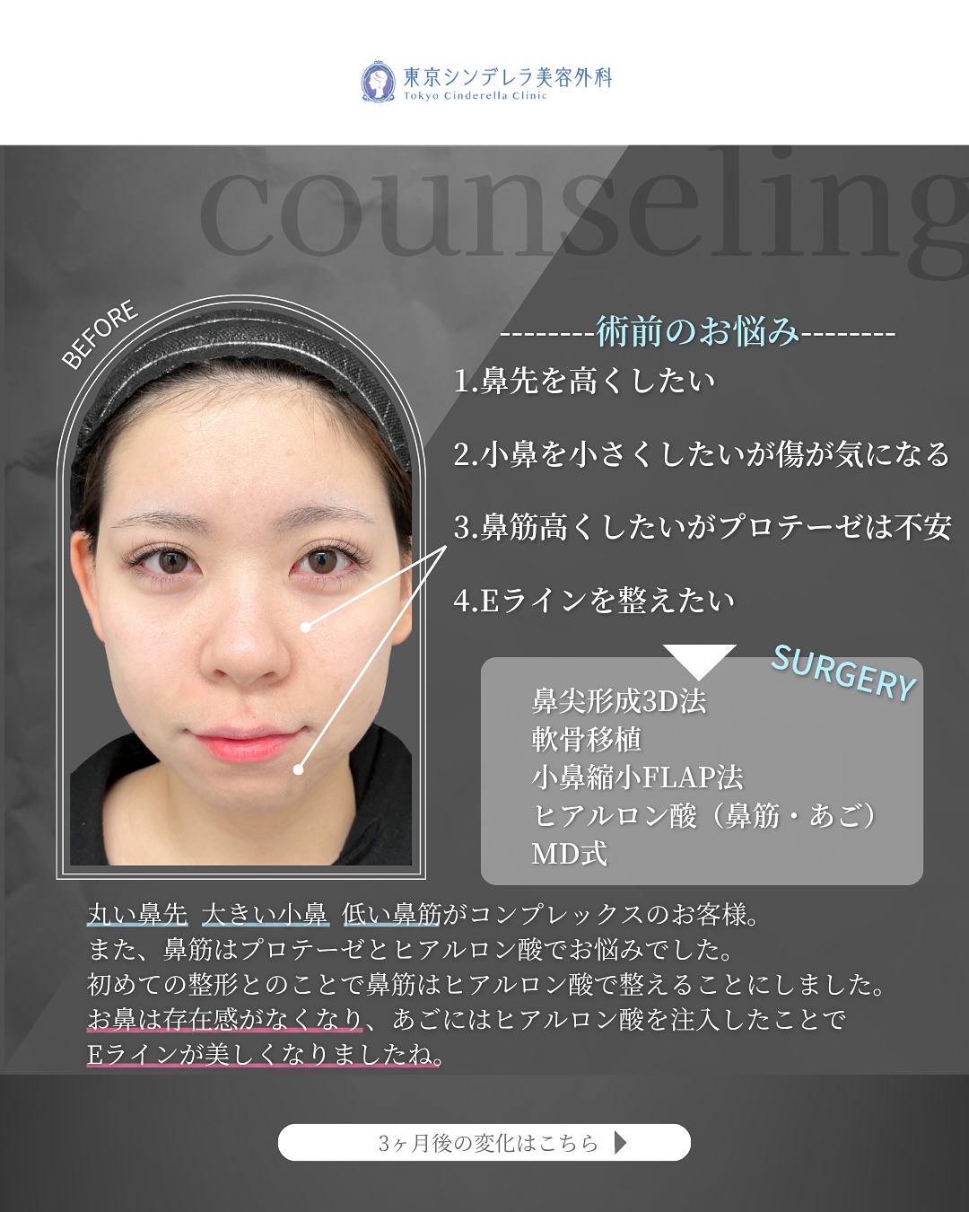 新宿院で行った鼻整形の名医の吉原伯医師のMD式の鼻尖形成3D法と軟骨移植と小鼻縮小FLAP法とあごヒアルロン酸の症例写真