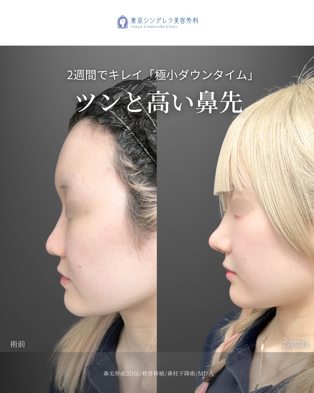 新宿院で行った鼻整形の名医の吉原伯医師のMD式の鼻尖形成3D法と軟骨移植と鼻柱下降術の症例写真