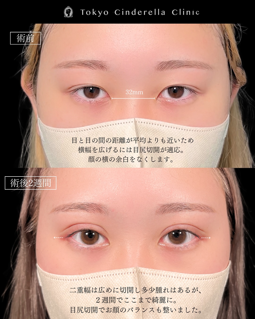 新宿院で行った二重整形の名医の吉原伯医師のMD式のたるみ取り併用全切開法二重術と眼瞼下垂手術と目尻切開の症例写真