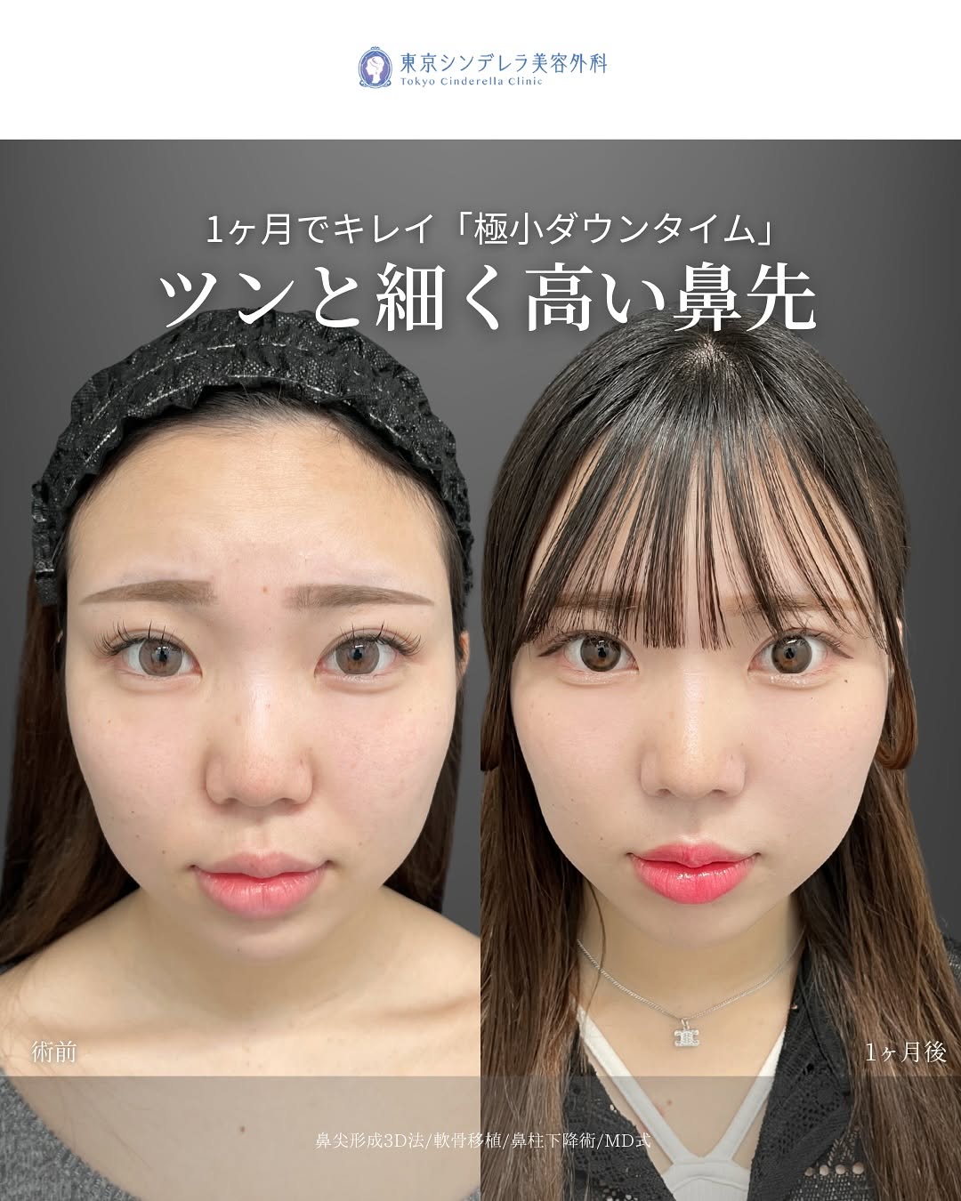 新宿院で行った鼻整形の名医の吉原伯医師のMD式の鼻尖形成3D法と軟骨移植と鼻柱下降術の症例写真
