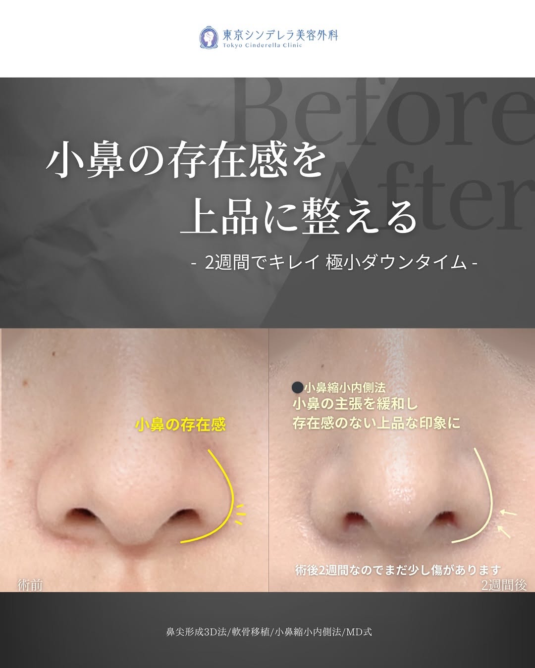 新宿院で行った鼻整形の名医の吉原伯医師のMD式の鼻尖形成3D法と軟骨移植と小鼻縮小内側法の症例写真