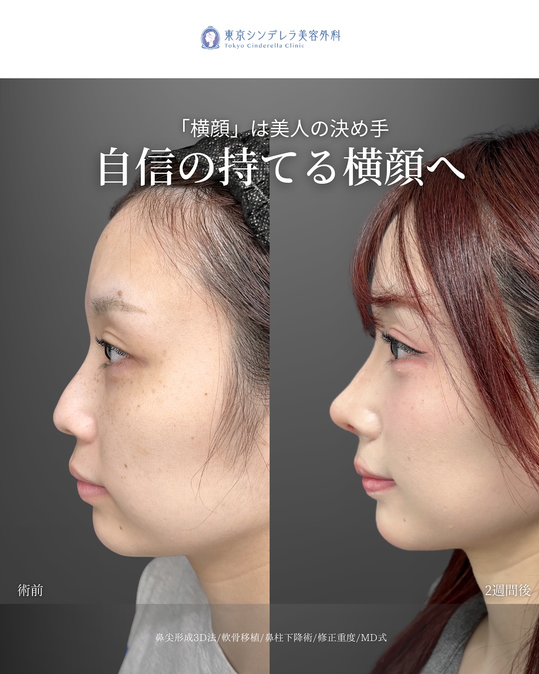 新宿院で行った鼻整形の名医の吉原伯医師のMD式の鼻尖形成3D法と軟骨移植の症例写真
