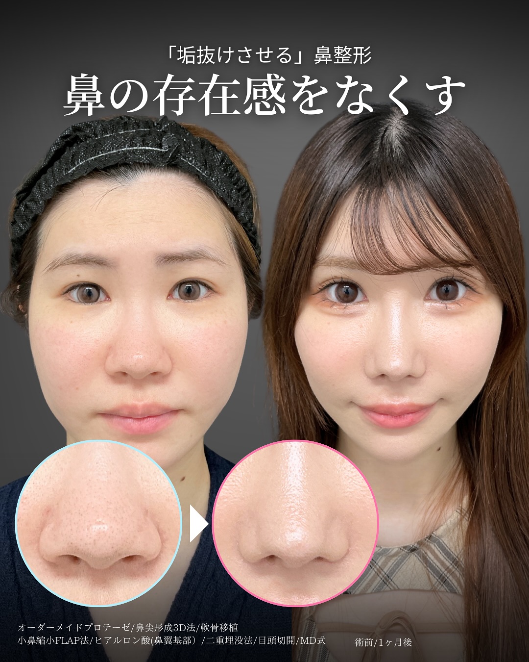 新宿院で行った二重整形の名医の吉原伯医師のMD式の鼻尖形成3D法と軟骨移植と小鼻縮小FLAP法とヒアルロン酸(鼻翼基部)と二重埋没法と目頭切開の症例写真