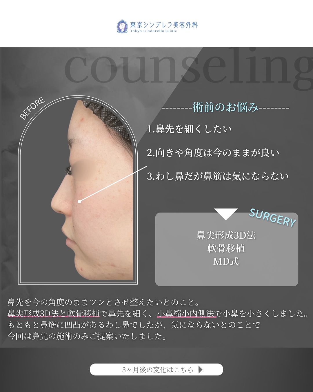 新宿院で行った鼻整形の名医の吉原伯医師のMD式の鼻尖形成3D法と軟骨移植の症例写真