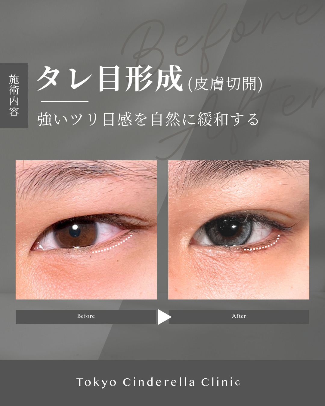 大宮院で行ったタレ目形成の名医の竹田昌平医師の症例写真