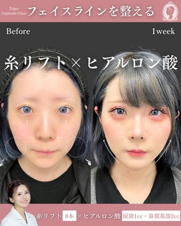 「糸リフト×ヒアルロン酸」でフェイスラインを整える✨