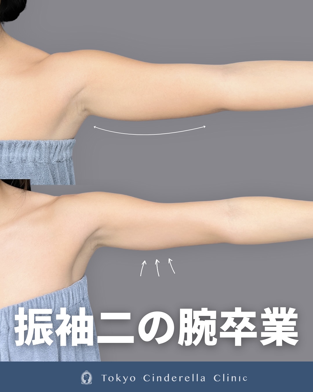 新宿院で行ったアキーセル脂肪吸引(二の腕・肩)の名医の吉原伯医師の症例写真
